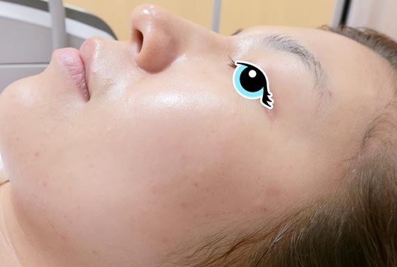 施術後