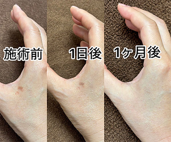光治療器