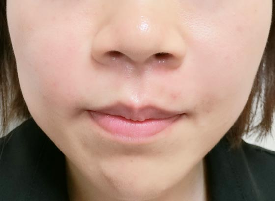 施術後