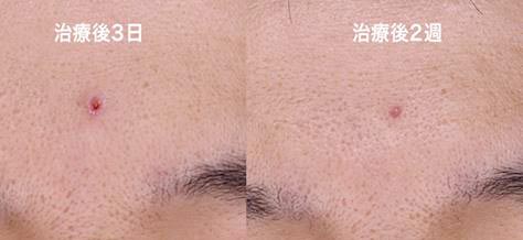 表皮化～約2ヶ月後